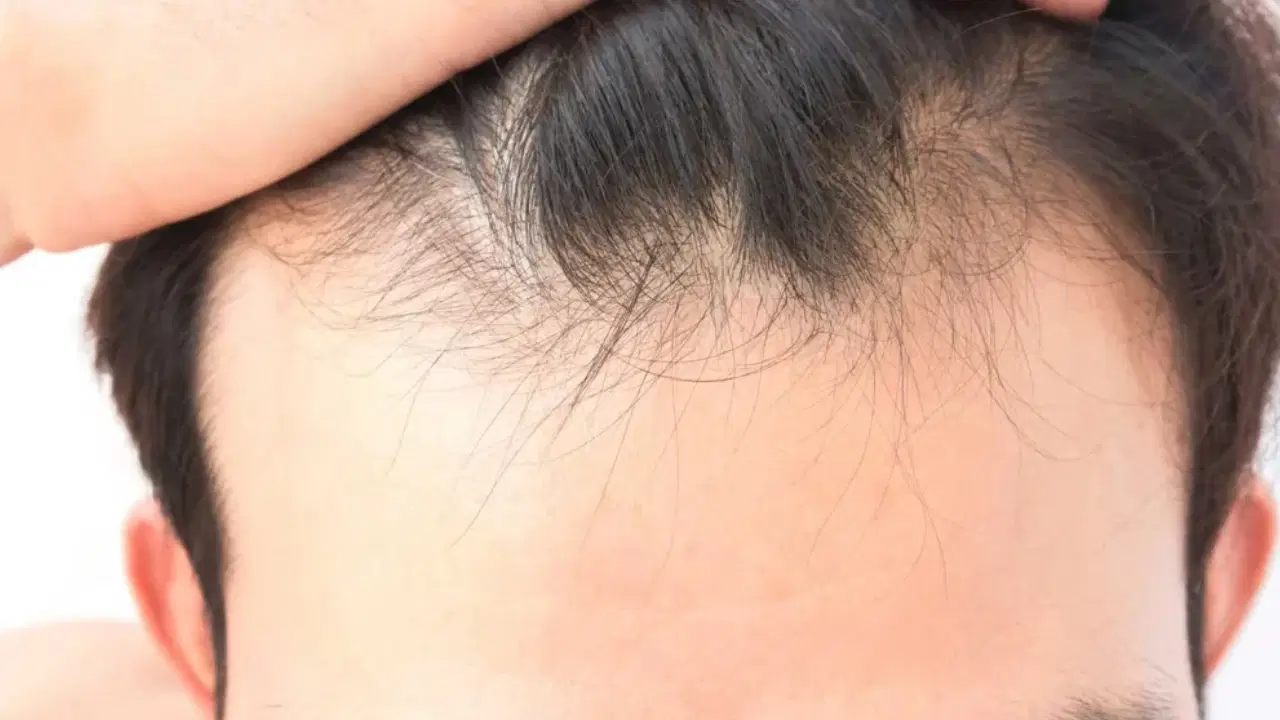 sac dokulmesinde gizli neden vitamin ve mineral eksikligi ne kadar etkili rbJZu3WZ.jpg